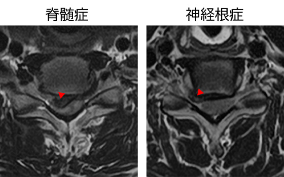 図 頚椎椎間板ヘルニア