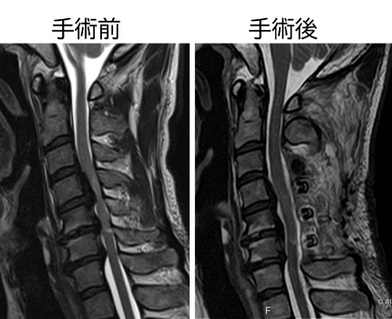 図 頚部脊柱管狭窄症 MRI 手術前後