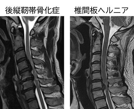 図 頚椎症性脊髄症