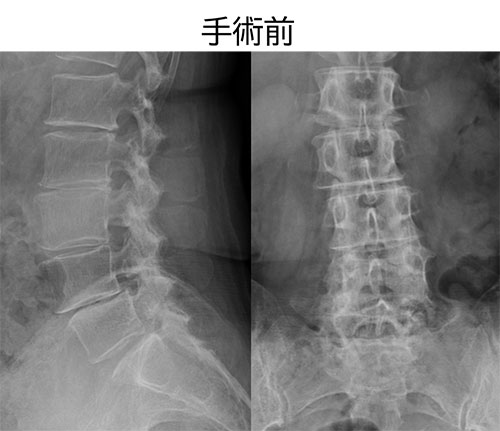 図 ME-PLIF レントゲン手術前