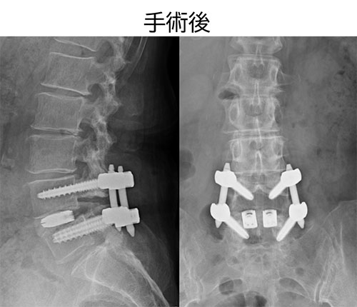 図 ME-PLIF レントゲン手術後