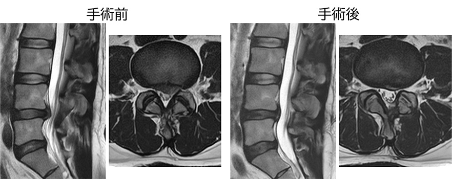 図 MED 手術前後MRI