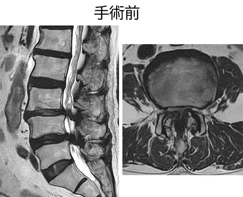 図 MEL MRI手術前