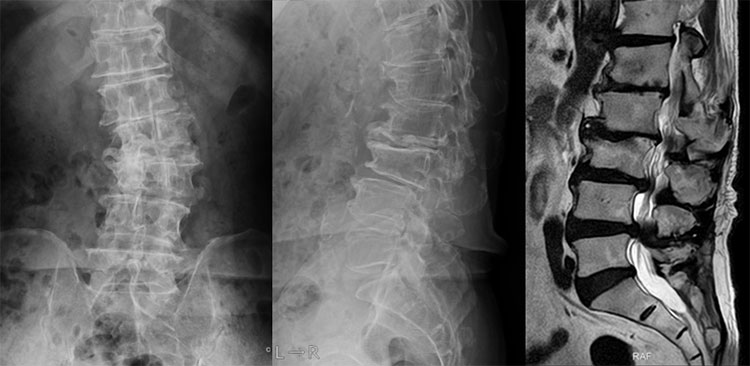 図　変性の強い腰部脊柱管狭窄症