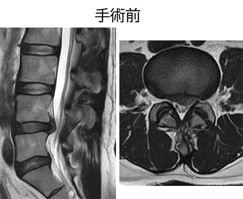 図 MED MRI手術前