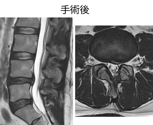図 MED MRI手術後