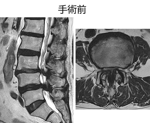 図 MEL MRI手術前