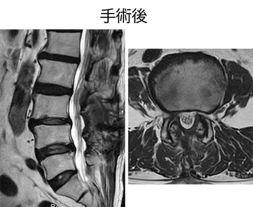 図 MEL MRI手術後